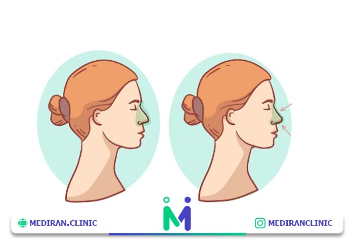 عمل جراحی بینی