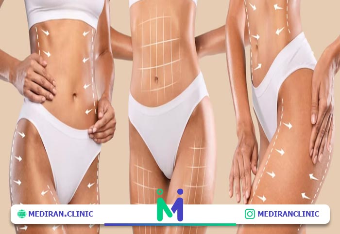 جراحی پیکرتراشی و مراقبت های آن